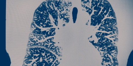 COPD versus hart- en vaatziekten