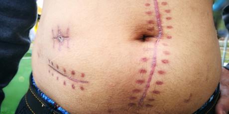 Oncologische follow-upzorg