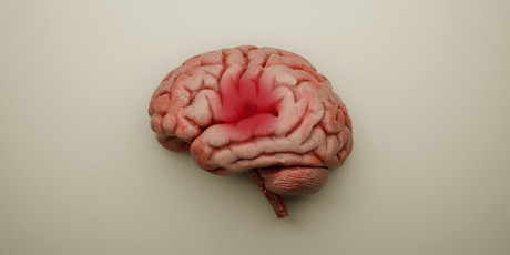De NHG-Standaard Beroerte is herzien vanwege een actualisatie van de NVN-richtlijn Herseninfarct en hersenbloeding. Foto: A Chosen Soul, Unsplash