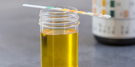 Doktersassistenten hebben kennislacunes rond het correct gebruik en de interpretatie van de urinestick. Foto: Shutterstock