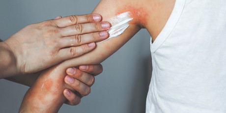 Een groot deel van de kinderen met eczeem krijgt niet de behandeling die ze nodig hebben. Foto: Shutterstock