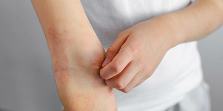 Een groot deel van de kinderen met eczeem krijgt niet de behandeling die ze nodig hebben. Foto: Shutterstock