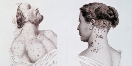 Koorts en huidreactie na syfilisbehandeling: herken de jarisch-herxheimerreactie.