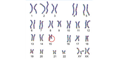 Bij PWS komt een essentieel stukje genetisch materiaal op chromosoom nummer 15 dat van de vader afkomstig is, niet tot uiting