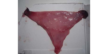 Decidual Cast Huisarts Wetenschap