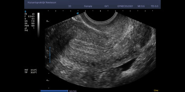 Transvaginale echo uterus