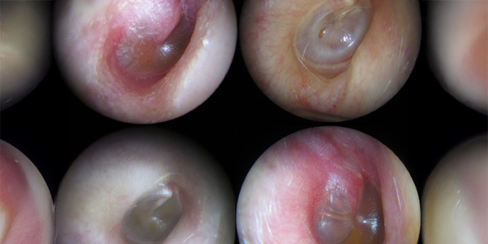 Fictieve AI-toepassing verbetert nauwkeurigheid bij diagnose oorontsteking. Shutterstock, bw