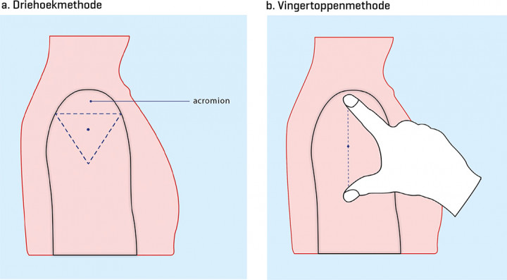 Technieken om de juiste injectiezone van de musculus deltoïdeus te bepalen: de driehoekmethode (a) en de vingertoppenmethode (b)