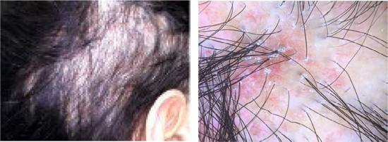 Een patiënt met cicatriciële alopecia (lichen planopilaris)