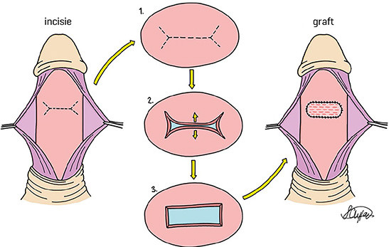 Operatieve mogelijkheden bij de ziekte van Peyronie: plaque-incisie of -excisie met grafting (IEG)