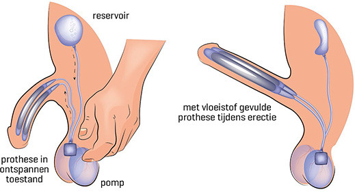 Operatieve mogelijkheden bij de ziekte van Peyronie: penisprothese