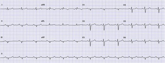 De afleidingen II, III en avF signaleren vooral activiteit uit de onderzijde van de linker ventrikel van het hart. Op dit ecg is in deze afleidingen geen R-top te zien, passend bij afwezigheid van elektrische activiteit in dit gebied. Dit is het gevolg van weefselverlies. Er is dus sprake van een oud ‘onderwandinfarct’.