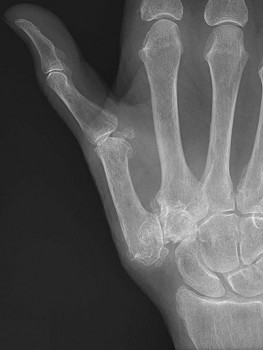 Een röntgenfoto ter bevestiging van de diagnose is niet noodzakelijk.