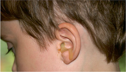 Kun je kinderen met een plots ontstaan loopoor behandelen met antibioticum oordruppels?