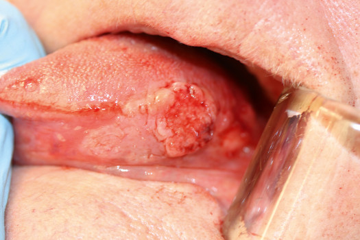 Een tongcarcinoom