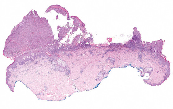Excisiepreparaat melanoom in HE-kleuring (10 maal)