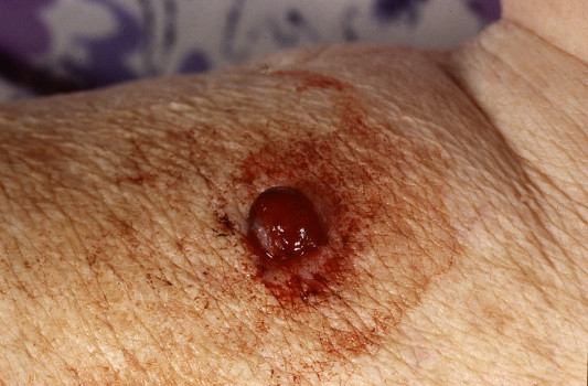 Een voorbeeld van een amelanotisch melanoom op de arm van een 82-jarige vrouw (met dank aan dr. J. Toonstra voor het ter beschikking stellen van de foto)