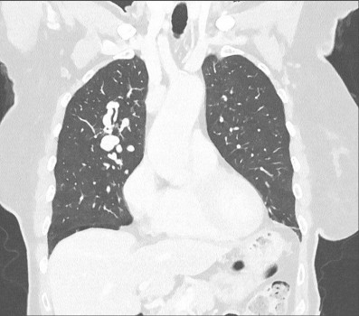Hogeresolutiecomputertomografie-thorax: pulmonale arterioveneuze malformaties in de rechter long