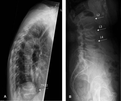 Röntgenopname van de thoracale (A) en de lumbale (B) wervelkolom in 2018