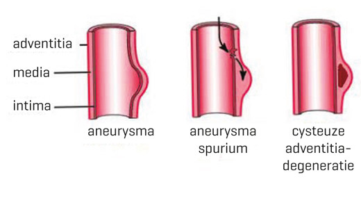Aneurysma, aneurysma spurium en cysteuze adventitiadegeneratie van de a. radialis