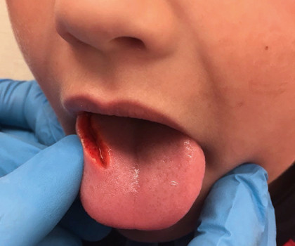 Een snijwond aan de laterale zijde van de tong