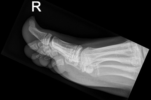 Een X-voet (laterale opname) van patiënt A.