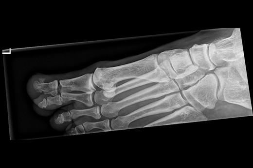 Een X-voet (driekwartopname) van patiënte B. De exostose is zichtbaar op de eindfalanx van digitus 1.