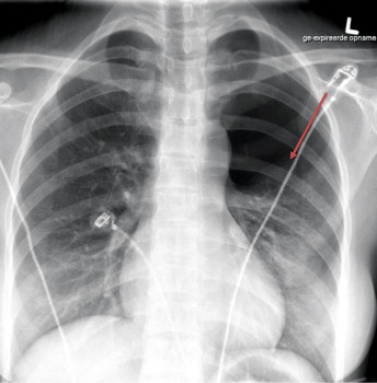 Voor-achterwaartse X-thorax met de pneumothorax (rode pijl)