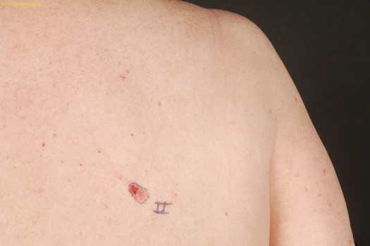 Voorbeeld van een patiënt met een superficieel basaalcelcarcinoom op de rug.