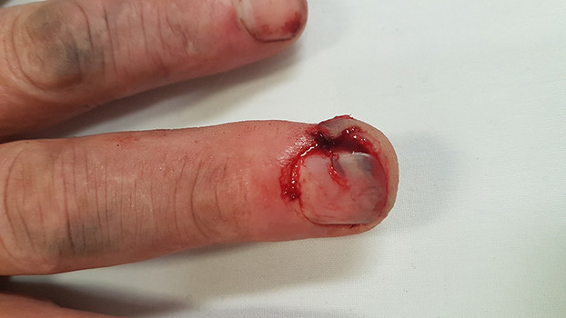 Beschadigde vingertop met laceratie van de nagel.