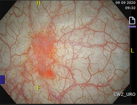 Cystoscopiebeeld met een relatief milde vorm van ketaminegeïnduceerde urotheelschade (een rode patch van lokale hyperemie)