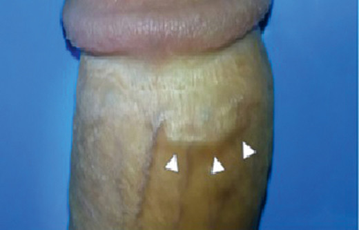 De kenmerkende kabelvormige zwelling op de dorsale zijde van de penis.