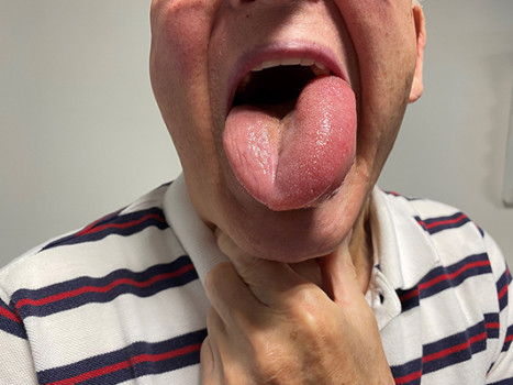 Angio-oedeem aan de linkerzijde van de tong