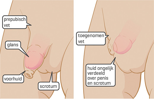 Normale penis (links) en buried penis (rechts)