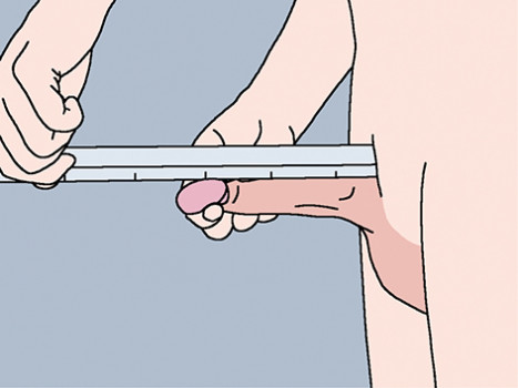 Het meten van de stretched penile length