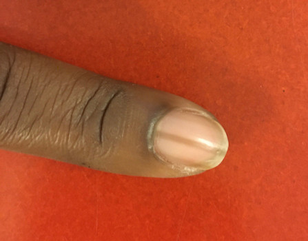 Verkleuring nagel: diagnostische vraag bij een 22-jarige vrouw met sinds enkele maanden een onveranderende streepvormige afwijking van de vingernagel van de wijsvinger links, geduid als melanonychia striata