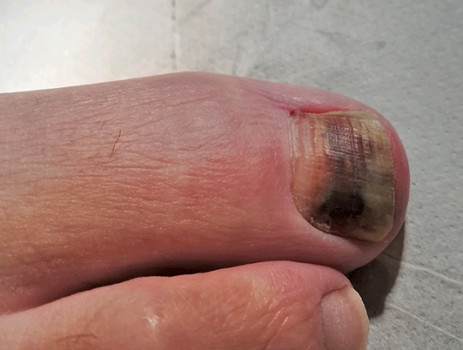Verkleuring nagel: diagnostische vraag bij een 60-jarige man met verkleuring onder de teennagel van de grote teen rechts die sinds 2 maanden vanuit de basis uitgroeit, geduid als subunguaal hematoom