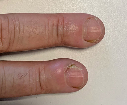Afwijking nagelriem: diagnostische vraag bij 53-jarige vrouw met sinds 2 jaar pijnlijke verdikte nagelriemen aan beide handen, geduid als chronische paronychia
