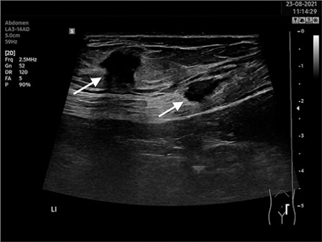 Op de echo van de patiënte zijn 2 endometriomen te zien in de subcutis en in de buikspier.