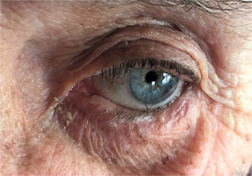 Entropion van het onderste linker ooglid, de wimpers komen lateraal tegen de conjunctiva aan en dat leidt tot irritatie