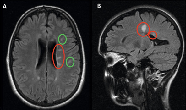 Voor MS kenmerkende MRI-afwijkingen