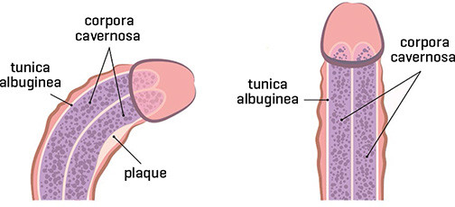 Anatomie en plaquevorming die tot kromming leidt bij de ziekte van Peyronie