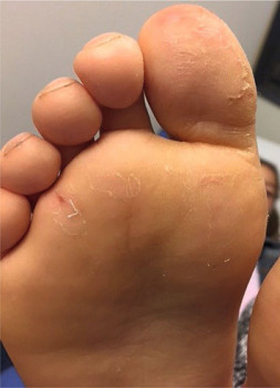 Kenmerkend voor juveniele plantaire dermatose zijn schilfers en pijnlijke kloven op de plantaire zijde van beide grote tenen en voorvoeten