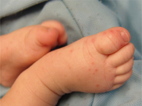 Voeten van een baby met gianotti-crostisyndroom