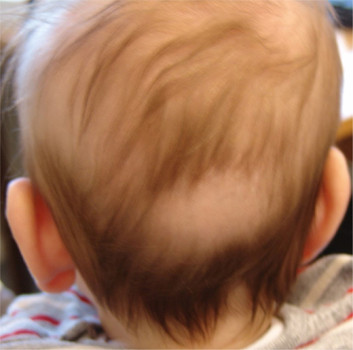 Afplatting van de schedel (met een kale plek op het achterhoofd) ontstaat door de voorkeurshouding in rugligging, in een zichzelf versterkend proces