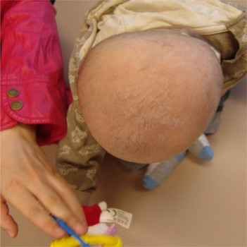 Door de vlakke afplatting van het achterhoofd kan de jongen zijn hoofd niet meer opzij draaien (hij kijkt naar beneden)