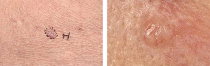 Klinische foto’s van een superficieel en nodulair BCC