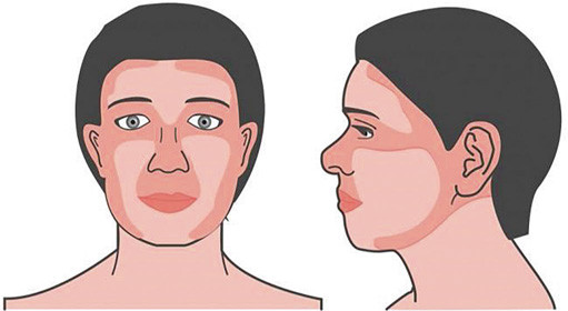 Illustratie van de zogeheten ‘H-zone’ in het aangezicht.