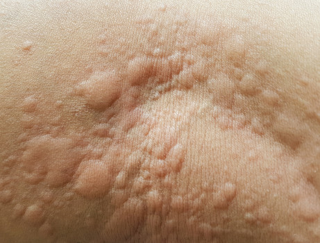 Urticaria kenmerkt zich door scherp begrensde, erythemateuze zwellingen met centrale bleekheid.
