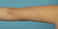 Gianotti-crostisyndroom op de arm